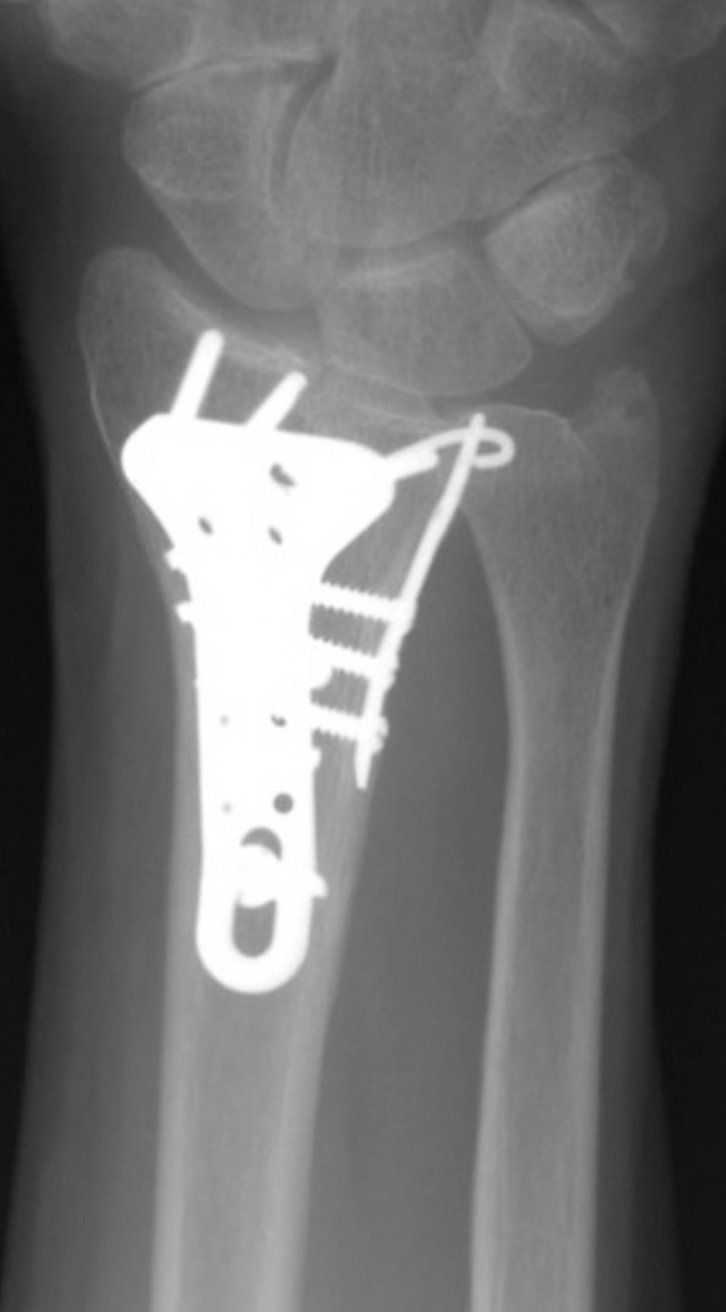 Synthes Distal Radius Plate (Implant 4266)